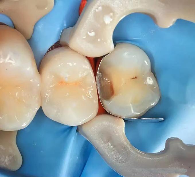 Dental Sectional Matrix System F2 Autoclavable includes Sectional Matrix Bands M2 + Resin Clamping Ring R3 3