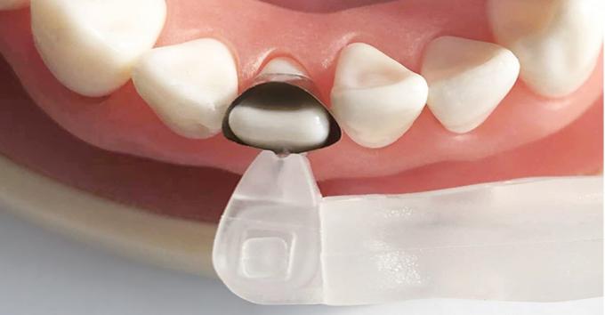 Universal Matrix Band Retainer M5 2.0 0