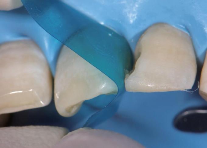 Sectional Contoured Anterior Matrix Band Dental Anterior Teeth Matrix M8 1