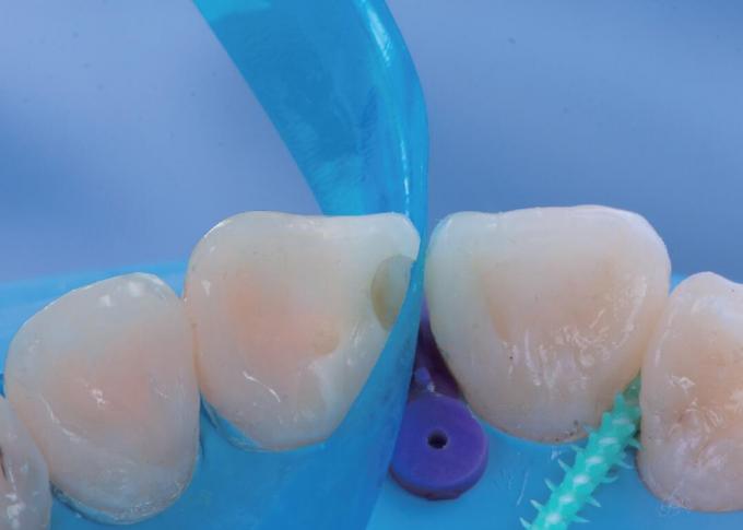 Sectional Contoured Anterior Matrix Band Dental Anterior Teeth Matrix M8 2