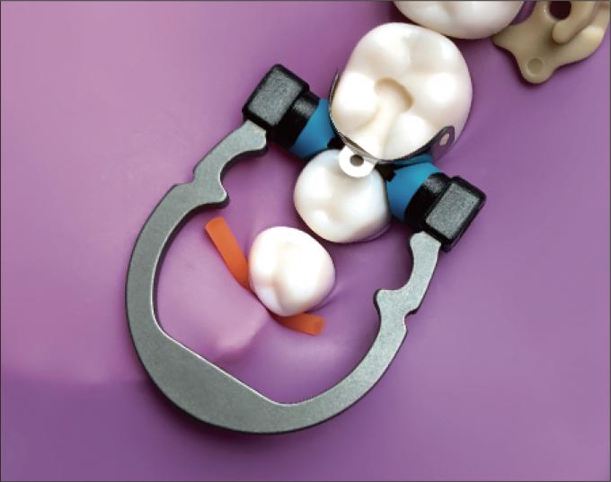 Triodent V3 Dental Sectional Matrix System Set Clamp Ring R5 1.0 1