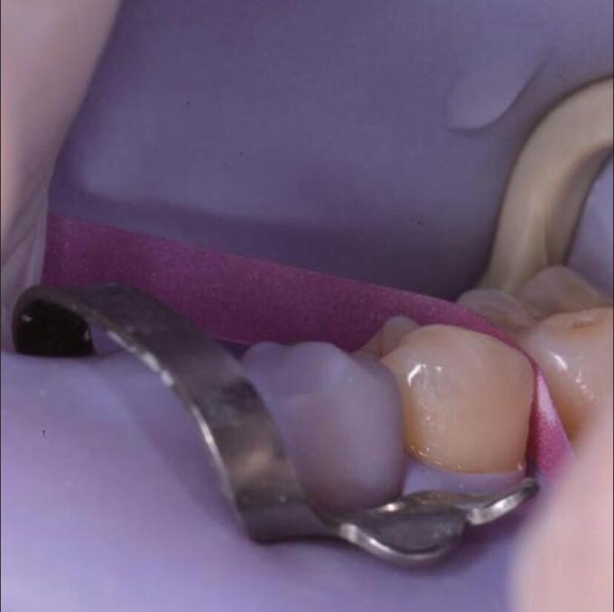 Sectional Matrix System Bands F3 G2 Oral Adjacent Surface Polishing Strip 0