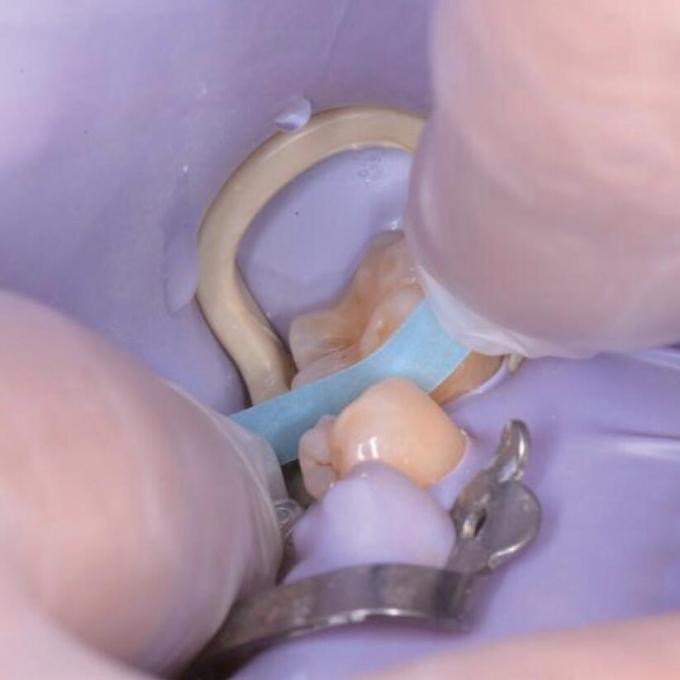 Sectional Matrix System Bands F3 G2 Oral Adjacent Surface Polishing Strip 1