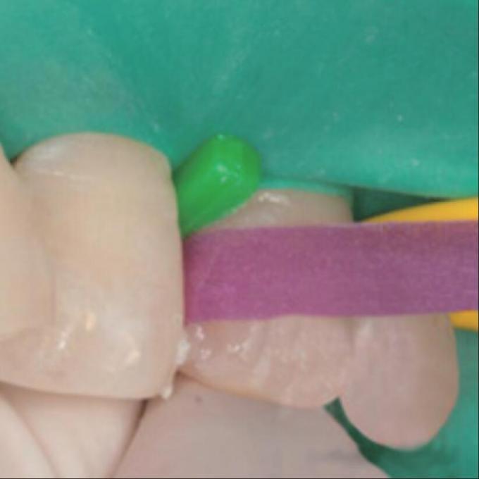 Sectional Matrix System Bands F3 G2 Oral Adjacent Surface Polishing Strip 2