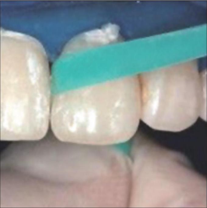 Sectional Matrix System Bands F3 G2 Oral Adjacent Surface Polishing Strip 3