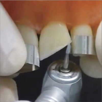 Dental Sectional Matrix System Steel Matric Bands  for Restorative Dentistry