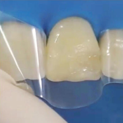 Anterior Matrix Strips Dental Roll Dental Resin Strip Roll